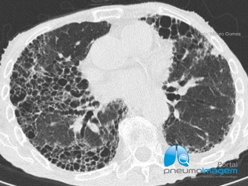 NINTEDANIBE FOI APROVADO PARA OUTRAS DOEN�AS FIBROSANTES PULMONARES
